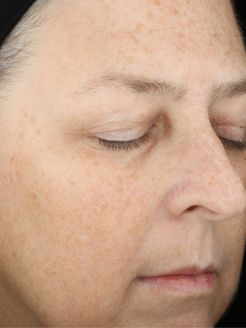 Before 1 is the example for the text of title in the before and after. Marykay before and after section